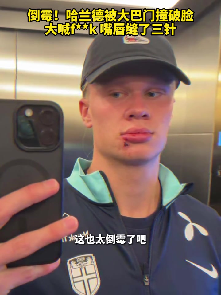 嘴角缝了三针！哈兰德被大巴车门撞破脸，现场大喊：Fxxk?